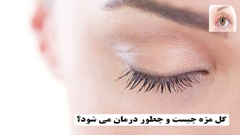 گل مژه چیست و چطور درمان می شود؟